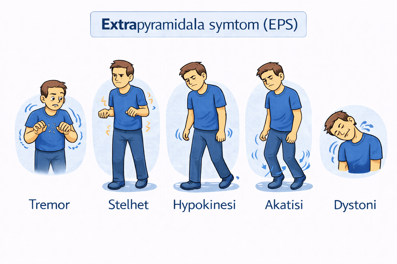 Illustration av fem vanliga extrapyramidala symtom: tremor, stelhet, hypokinesi, akatisi och dystoni
